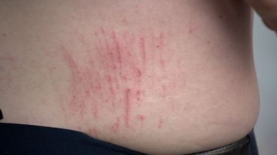  This photo shows scratches Mr Jones said he received on his back