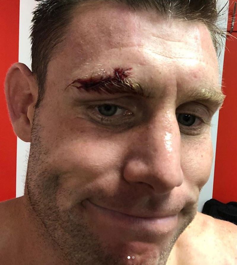 James Milner showed off the stitches he required after a clash of heads against Southampton 