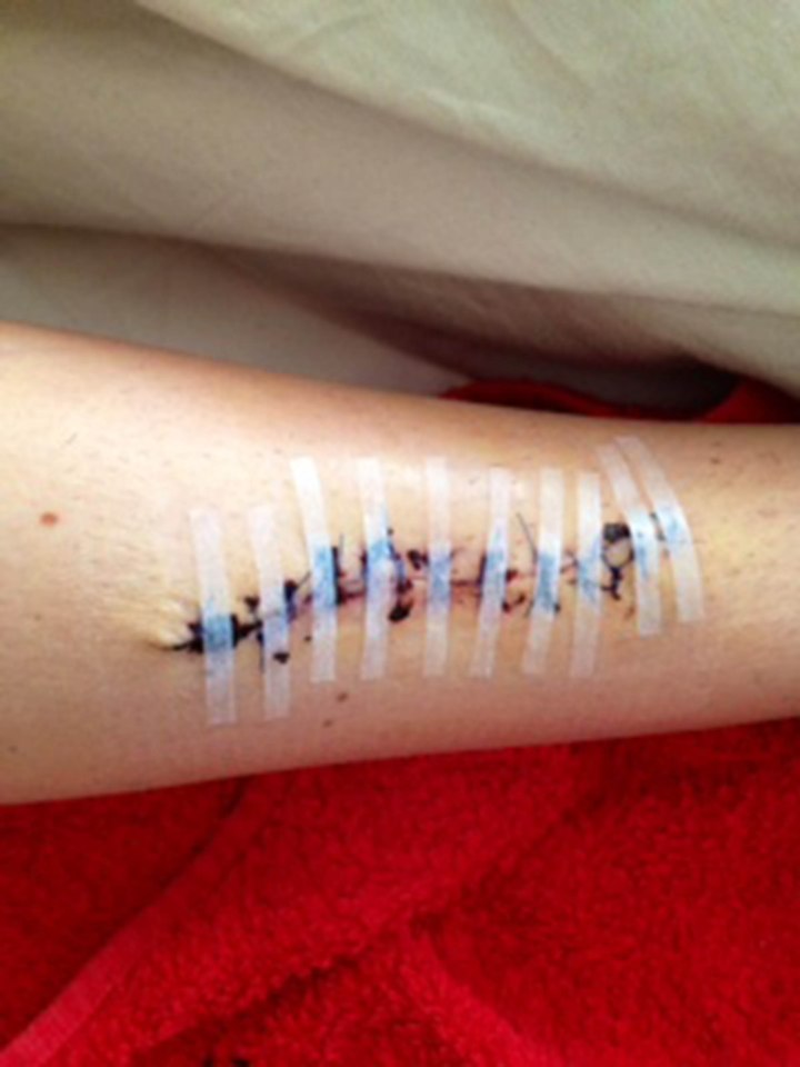  Jenni Bradys leg after she had to have a part of it removed in 2013