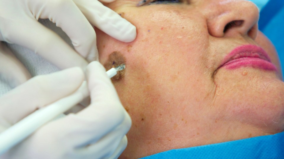 Grandmother Lili at The Bad Skin Clinic having her 10-year-old facial wart removed