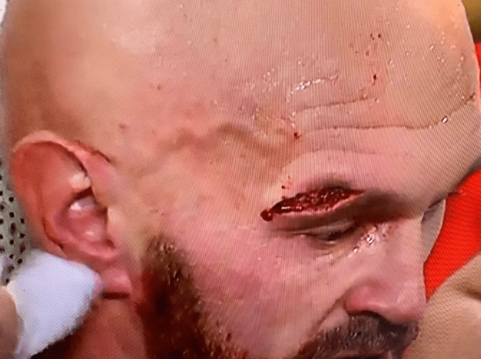  The gash on Fury's eye was gruesome