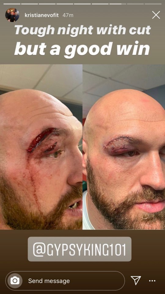 Tyson Fury has shown off the before and after pics of his horror eye cut