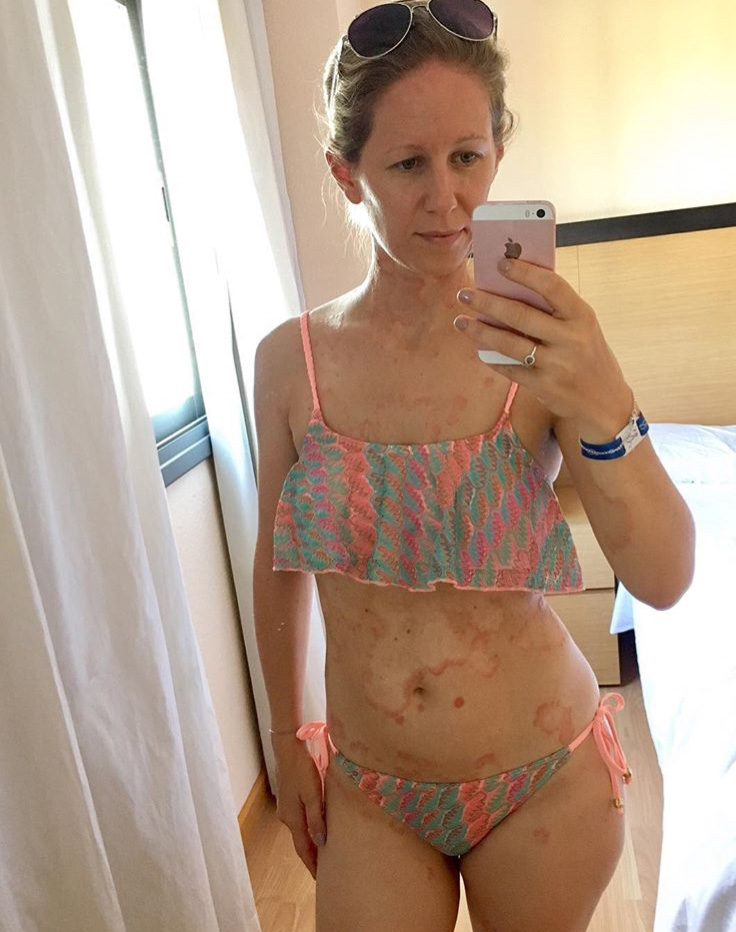  Laura Parish, 37, was first diagnosed with psoriasis when she was just two and it eventually covered her entire body