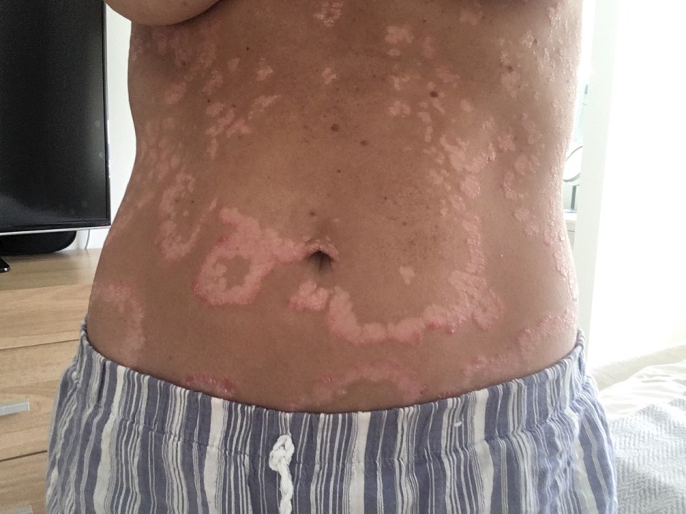  All the methods Laura has tried to heal her skin have worked for a limited time before her psoriasis came back angrier than ever