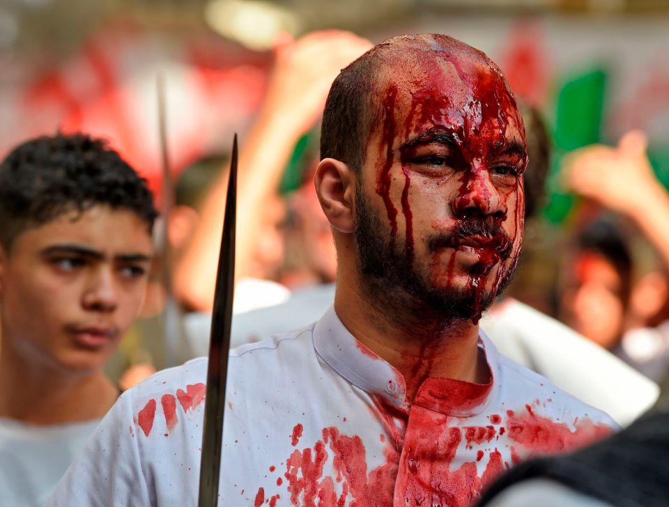  A man in Bahrain in the process of bloodletting