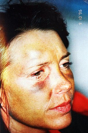  Bruises on Margaret Moore's face in 1996