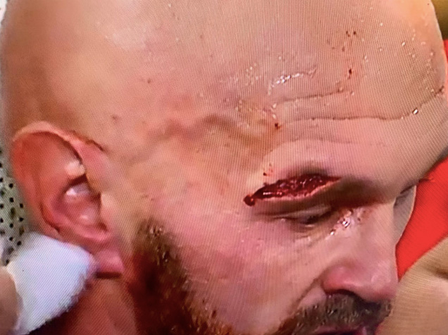  Tyson Fury required stitches on the two-inch gash above his eye