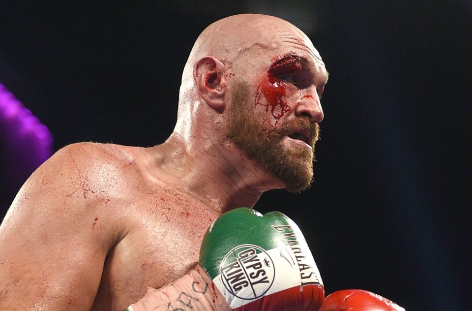  Tyson Fury has had the 47 stitches in his cut eye removed nine days after fighting Otto Wallin