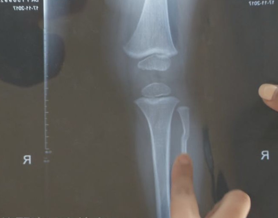  An X-ray shows the boy's bent fibula after the fall