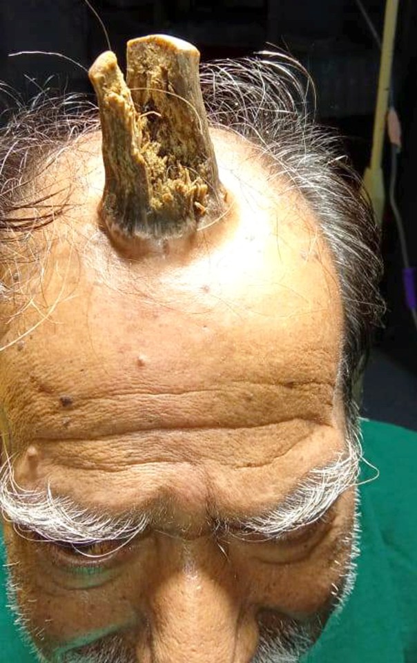  The growth sprouted from the man's scalp after he bumped his head