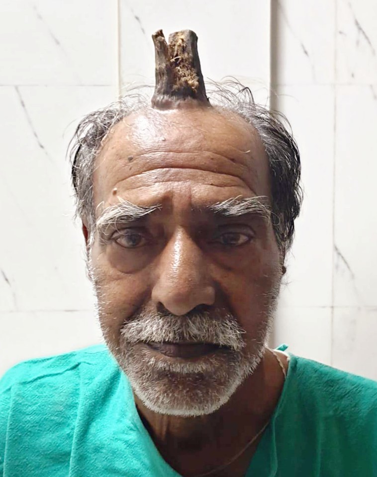  Shyam Lal Yadav, 74, said the unicorn-like horn started growing from his head around five years ago