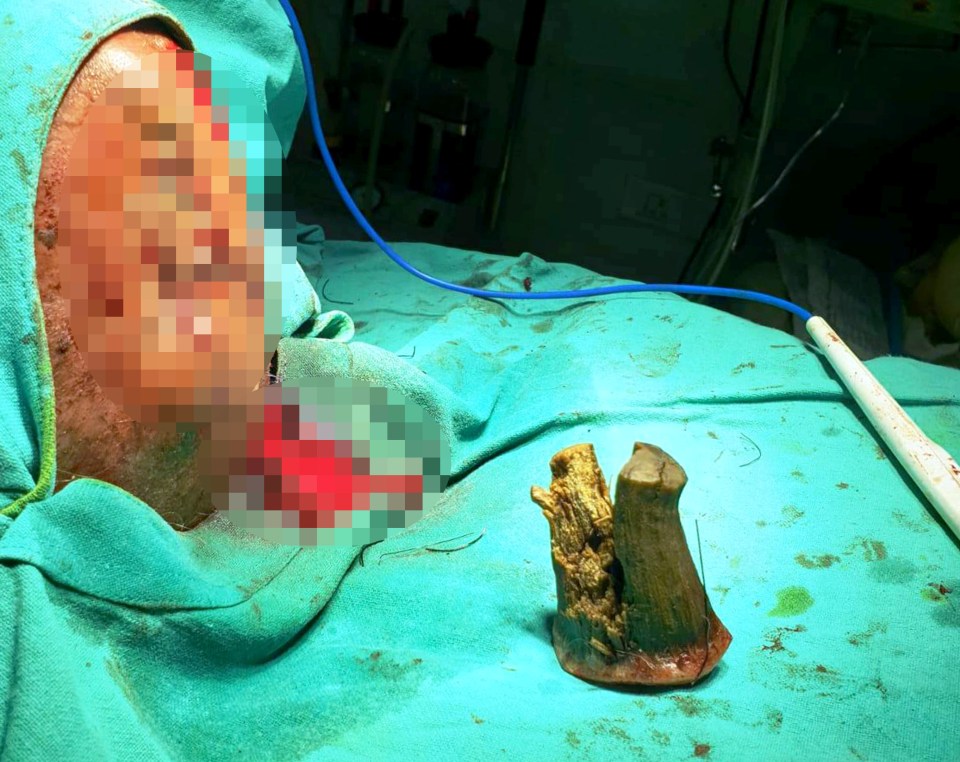  Surgeons removed the horn with a razor and will treat the root cause of the growth to prevent it from returning