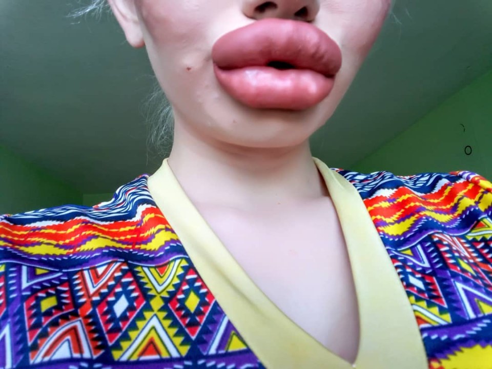 The procedures she has had require hyaluronic acid to be injected into her lips