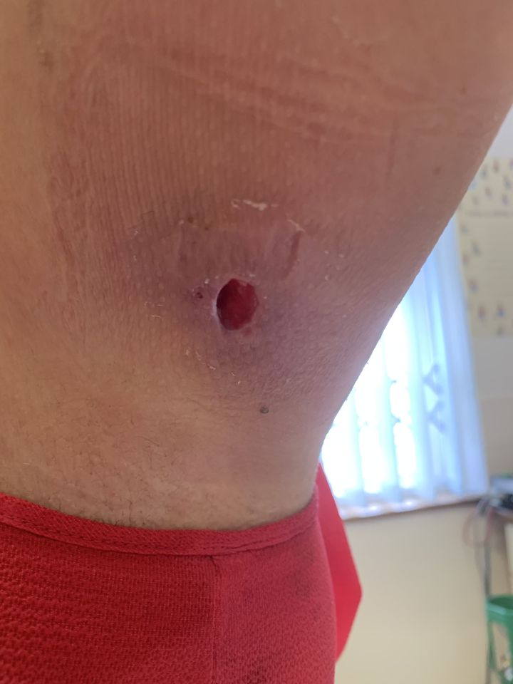  Louise was left with a one-and-a-half-inch hole in her arm