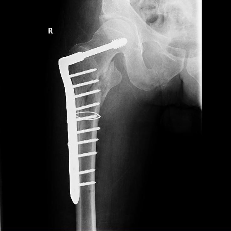  An x-ray of Paul's broken femur, shattered in the fall