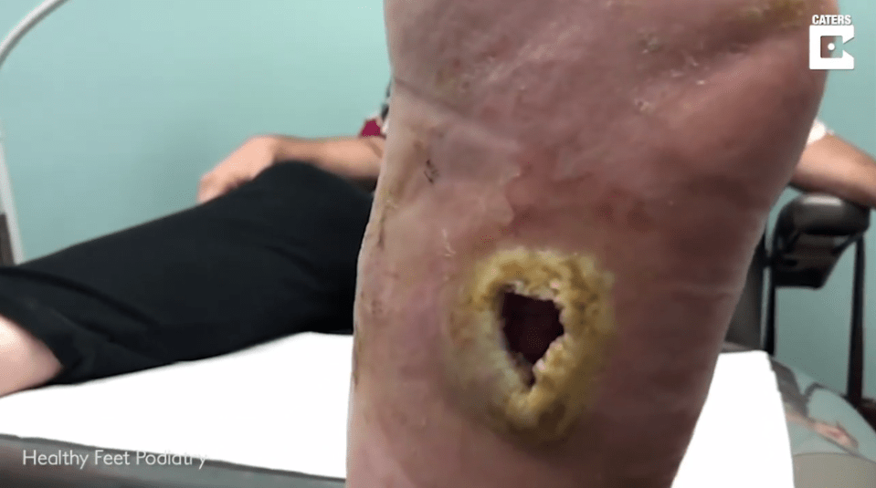  This is the gaping hole that a woman was left with on the sole of her foot due to diabetes