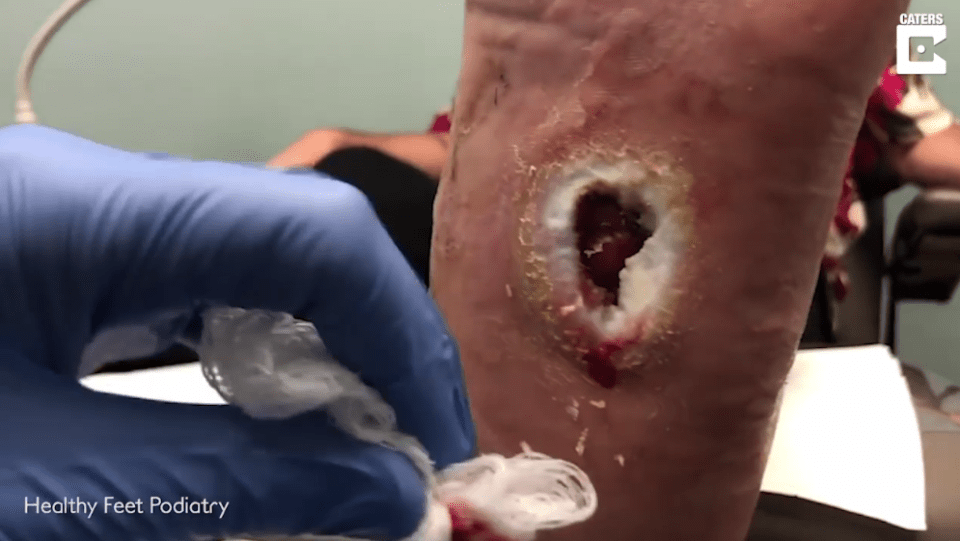  The stomach-churning footage shows Dr Todd Brennan treating her large, gaping sore