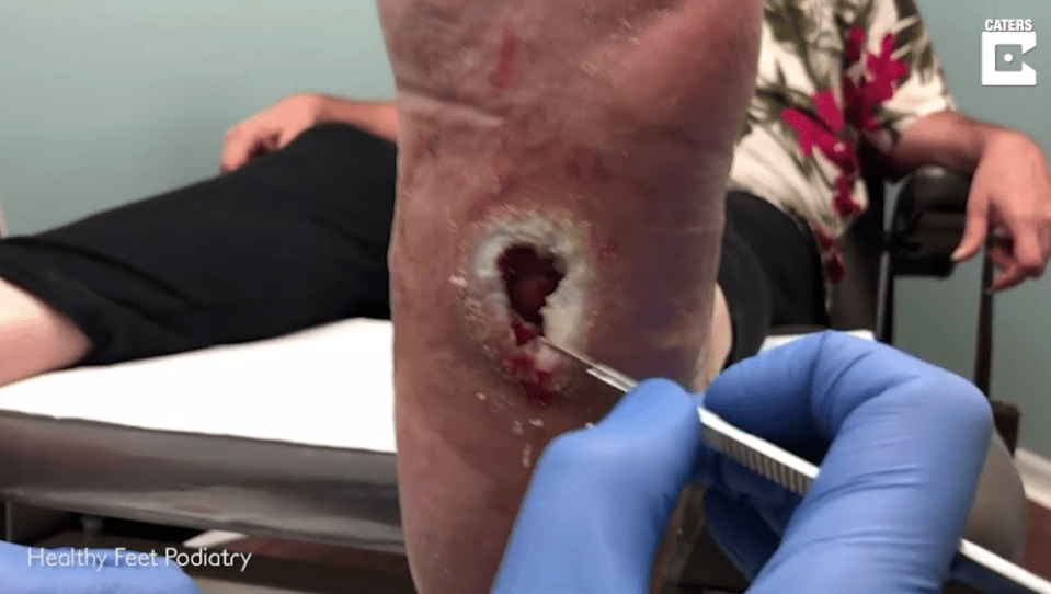  He used a scalpel to scrape away at the 'wet' tissue so that her wound can heal