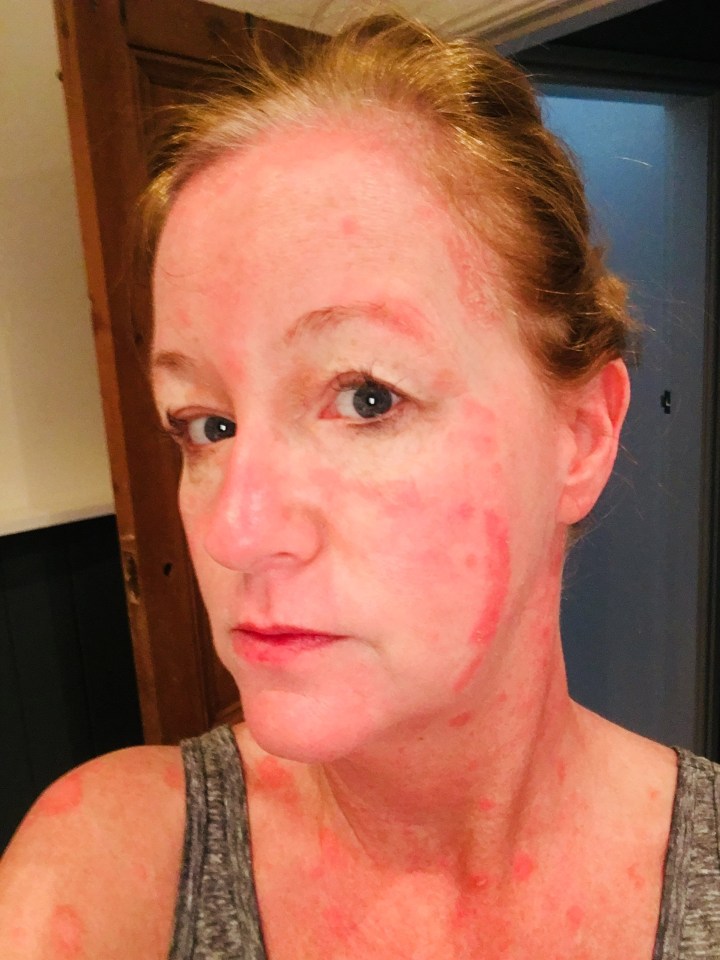  Paula even had psoriasis on her face which left her feeling 'abnormal'