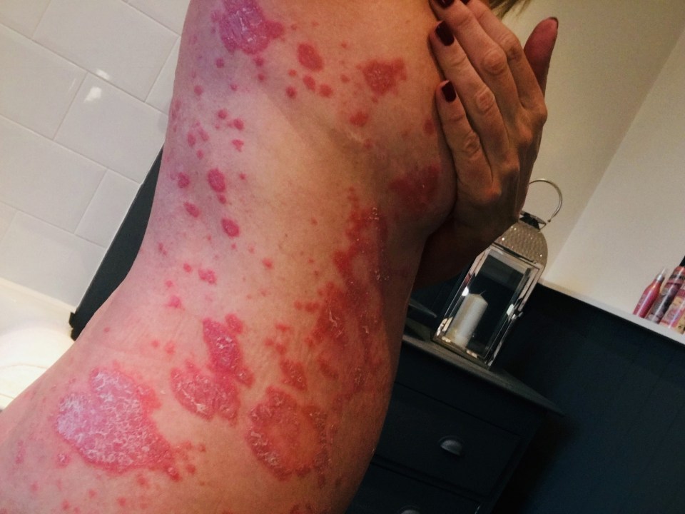  She says she put up with painful psoriasis for 35 years before finally finding a way to soothe her skin