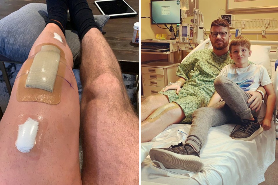  UFC legend Michael Bisping shared an image of his massively swollen  leg after undergoing a knee replacement