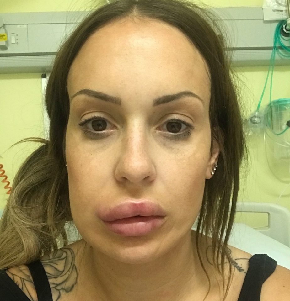  Mum-of-two Siobhan Phelan, 30, nearly lost her top lip after paying £125 for lip fillers she saw on Facebook