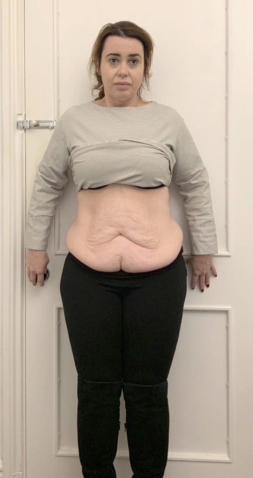  Victoria has been left with a stone-and-a-half of excess skin hanging from her tummy