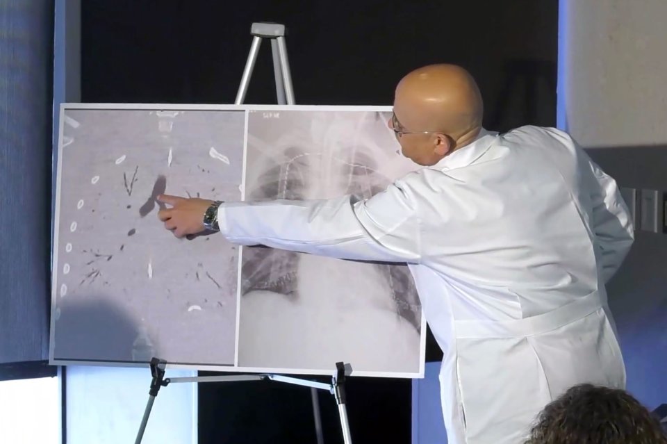  Dr Hassan Nemeh, Surgical Director of Thoracic Organ Transplant, shows areas of the patient’s lungs