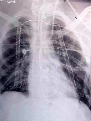  The new lungs show a much clearer picture and are helping the teenager to recover