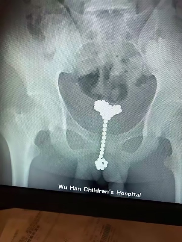  A 12-year-old boy was found to have 31 magnetic balls lodged in his bladder after shoving them up his penis