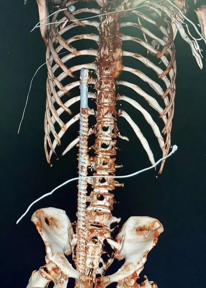  A 3-D x-ray shows a metal bar that impaled a man after he fell onto it while working on a construction site in China