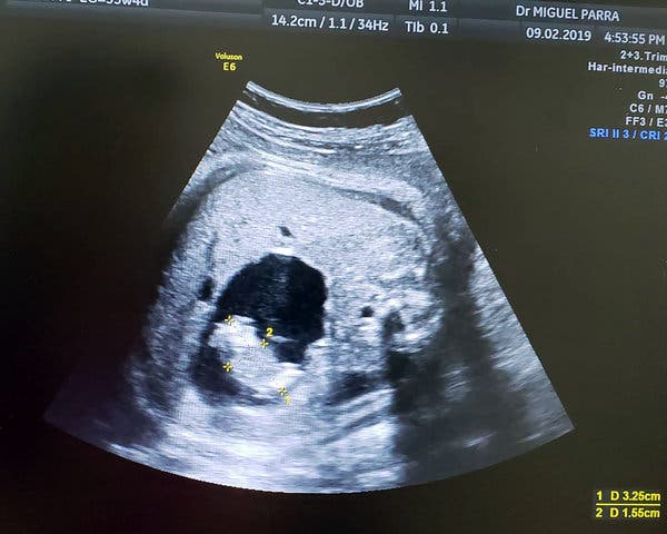  A scan shows the tiny fetus forming in the abdomen of her twin sister while in the womb