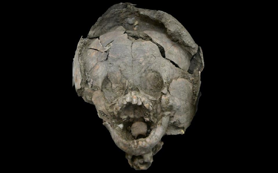  Infant discovered in Ecuador with a 'skull helmet'