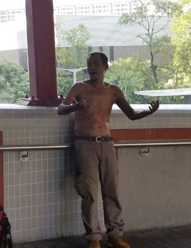  The man was pictured after the attack with visible burns to his torso and arms