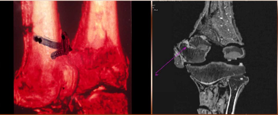  CT scans of Tut's left thigh bone. The arrows point to a suspected fracture