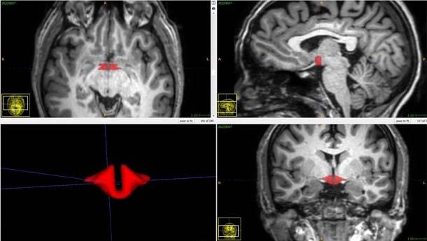 A brain scan showing the smaller hypothalamus in red