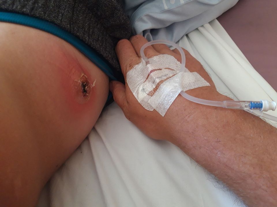  He had to have a skin graft in hospital, using a large square of skin from his thigh