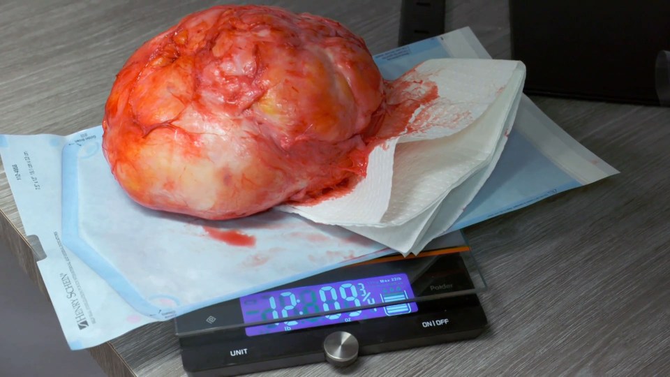  The lipoma weighed more than a newborn baby