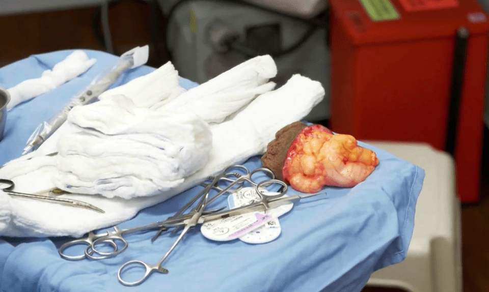  The fatty lump lies on the table after surgery while Dr Lee sews up Ravon