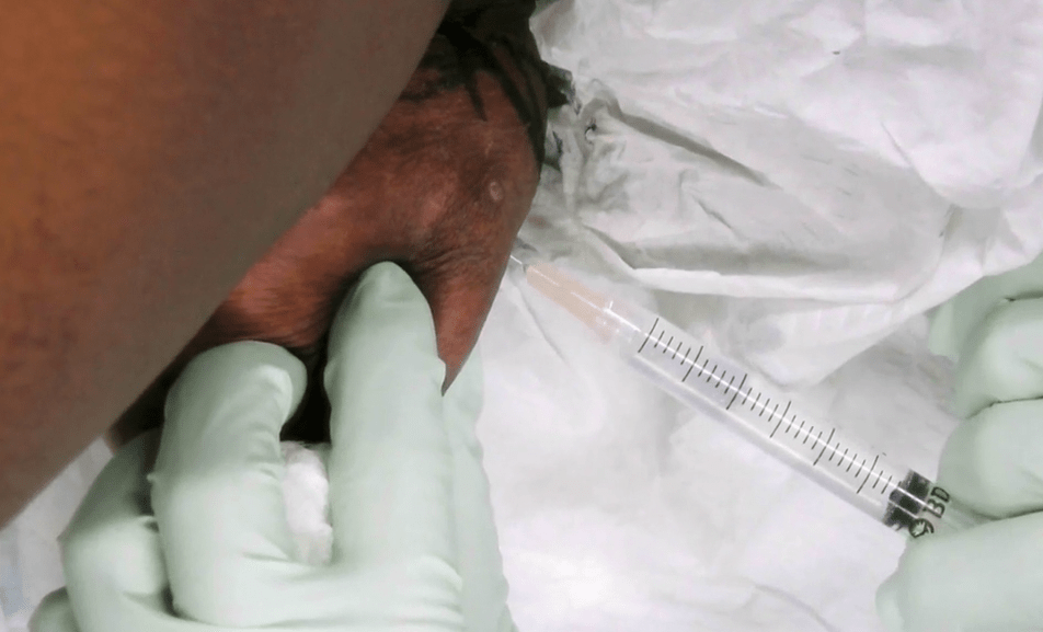  In surgery, Dr Pimple Popper injects the growth with a numbing fluid