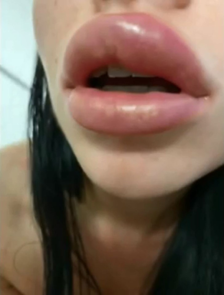  Her lip swelled up following the botched injection