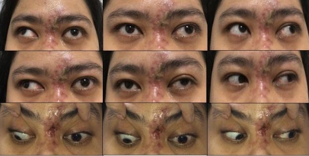  A 30-year-old woman from Indonesia suddenly went blind after having filler injected in her nose