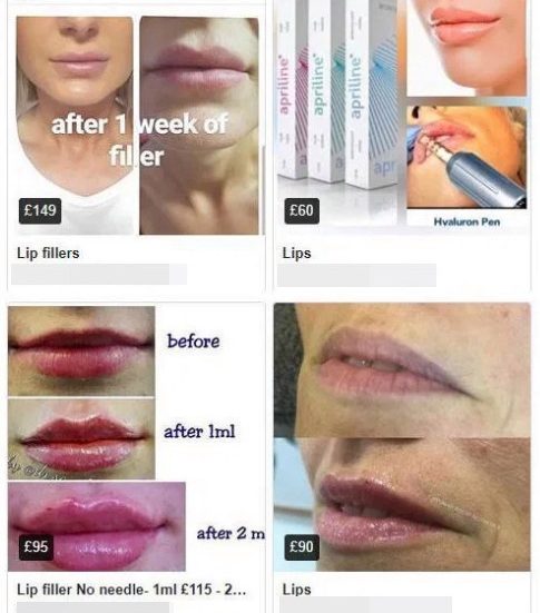  Hundreds of sellers are advertising lip fillers on Marketplace