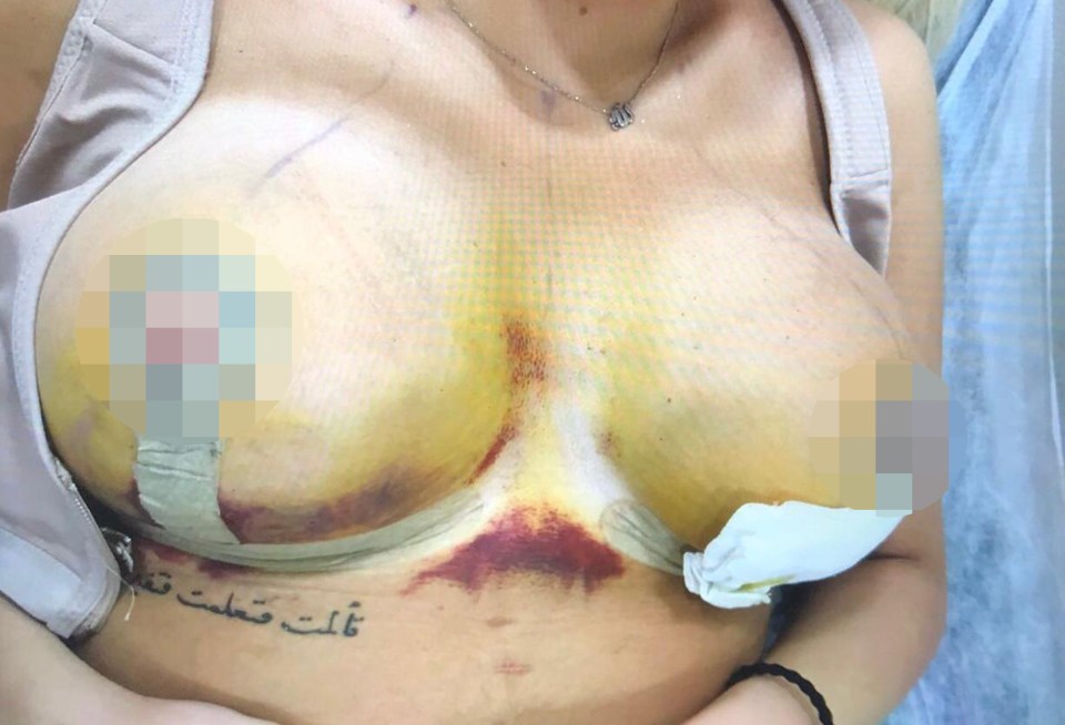  Her boobs were badly bruised after the first op and medics in the UK discovered a capsular contraction