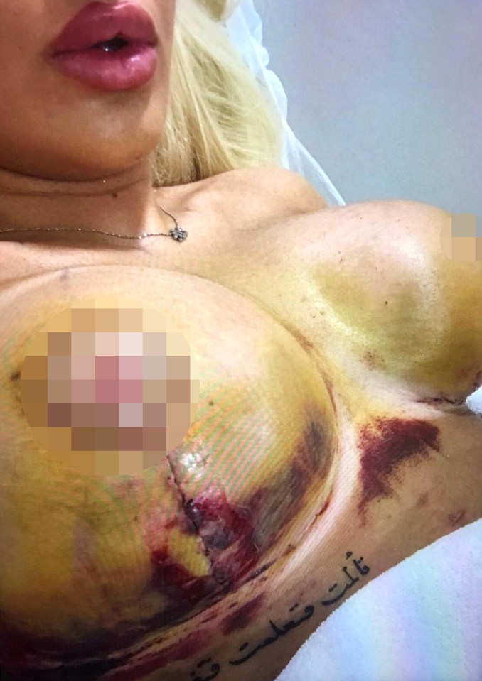  Her first operation left her with a hole in her breast and a deformed shape, she claims