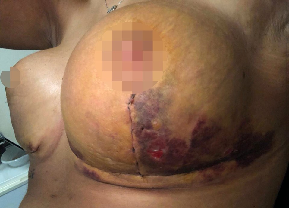  The retail manager had been on the quest for the 'perfect boobs' but was left with horrific scars and bruises, pictured after the first op