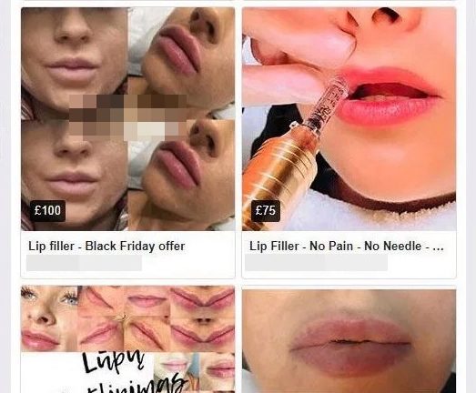  Facebook Marketplace adverts for lip fillers, featuring 'before-and-after' pictures, stock images and special offers