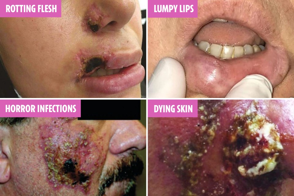  These are some of the horrific case reports we uncovered showing shocking cases of infection, rotting skin and lumps after having fillers