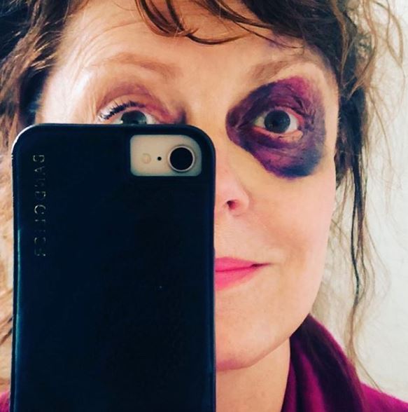  Susan Sarandon last year showed off a nasty black eye on her Instagram