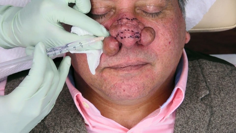  Dr Sandra Lee starts off by injecting his nose with a numbing fluid so he won't feel the surgery